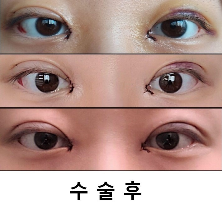 눈수술 후 기