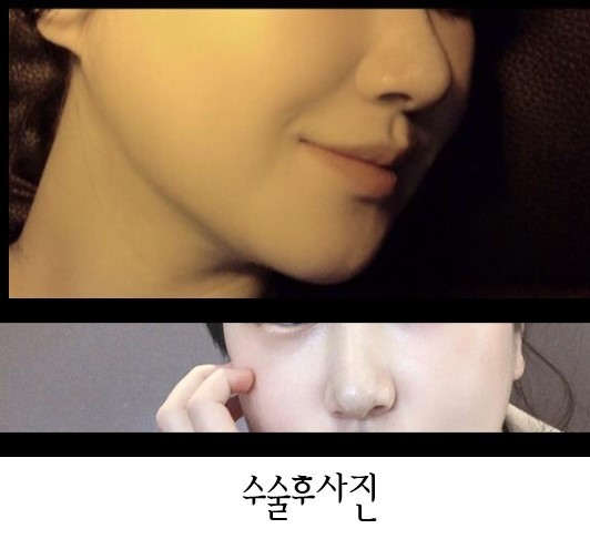 복코수술