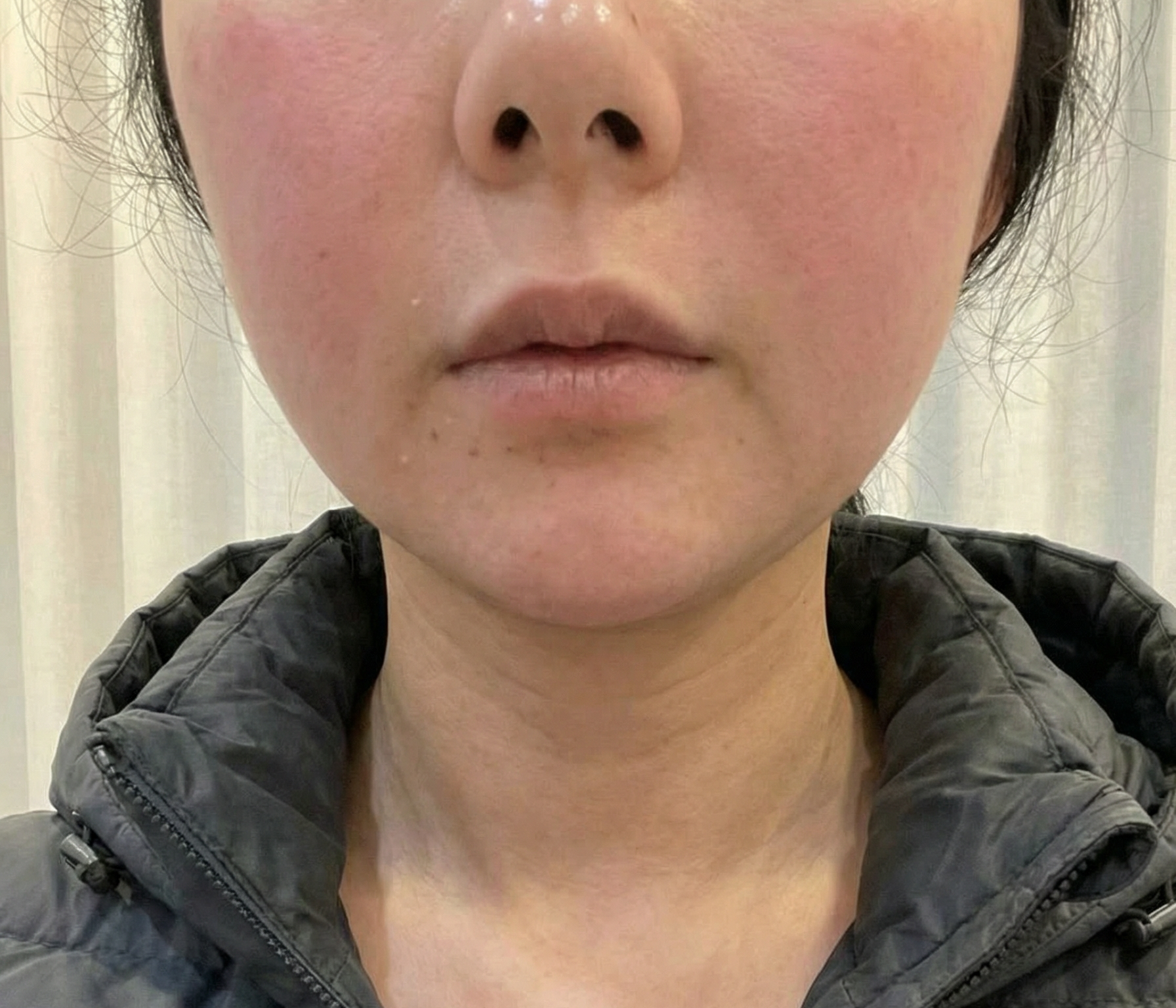 친구 소개로 목주름 시술 받았는데 만족이에요