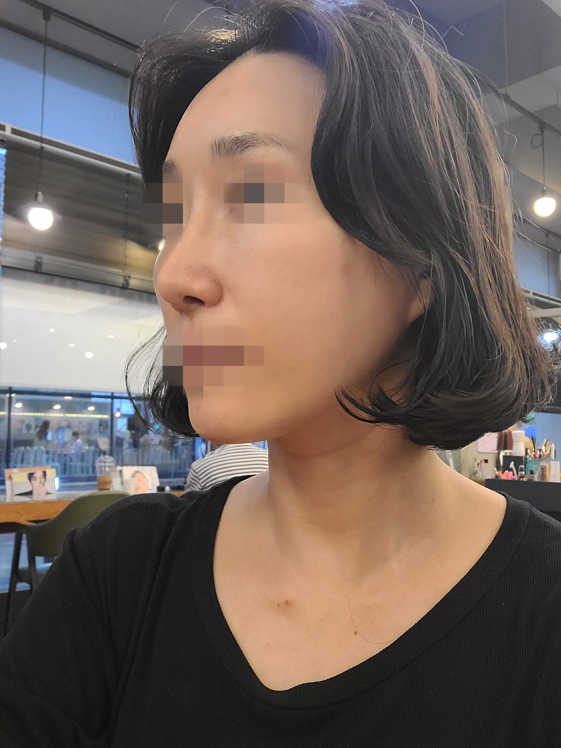 코재수술후 벌써 두달이되었네요! 지금은 붓기도 다빠지고 점점 예쁘게 자연스럽게 자리잡고있어요!!