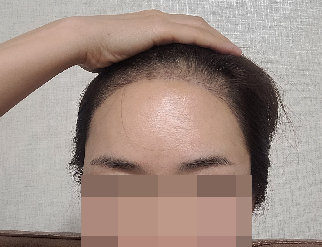 10년 만에 다시 받은 헤어라인 모발이식, 어느새 2주차 됐어요