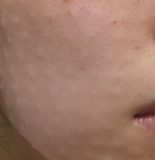 계절 상관없이 악건성 피부 챙기려고 리쥬란 처음 받으러 왔어요!