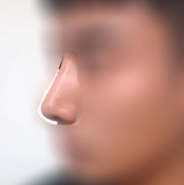남자 매부리수술후기