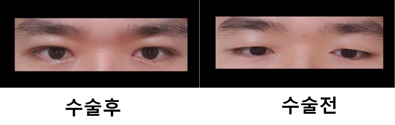 눈매교정 쌍꺼풀 수술