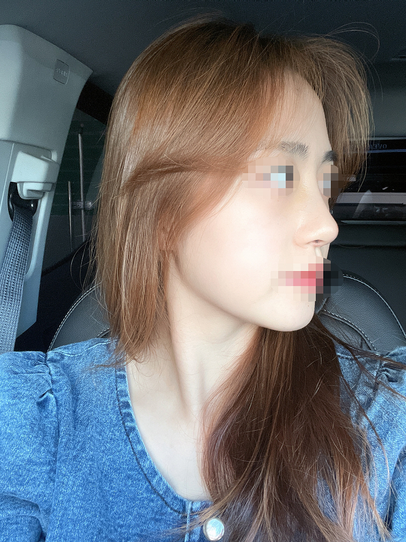 자연스럽게 예뻐졌어요 일주일차 치고 멍도 붓기도 없는편이고 예뻐요 너무 마음에 듭니다