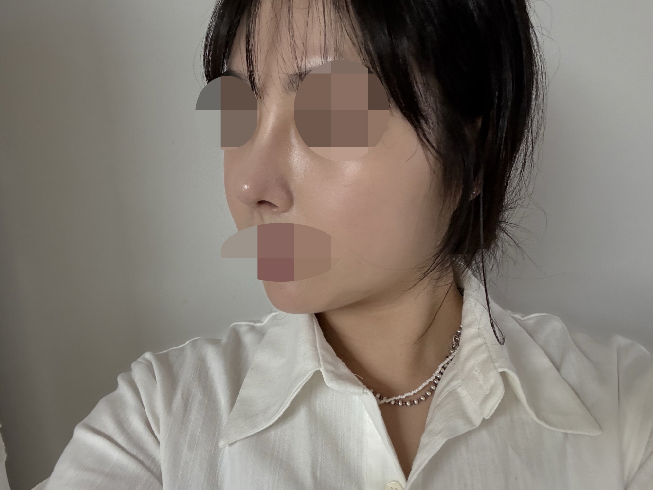 진짜 엄청 자연스러운 거 원했는데 너무 잘 됐어요! 붓기 빠진 후에 더 맘에 들거 같아요 ㅎ