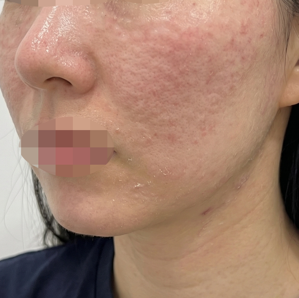 대표원장님께 받았는데 엠보 촘촘해서 일부러 찾아오길 잘한 것 같아요 ㅎㅎ