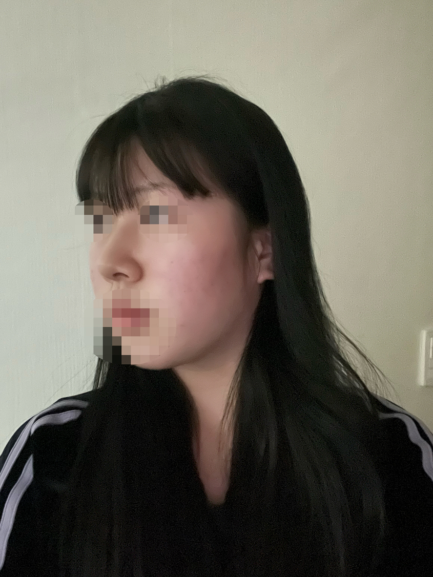코 수술 받았어요