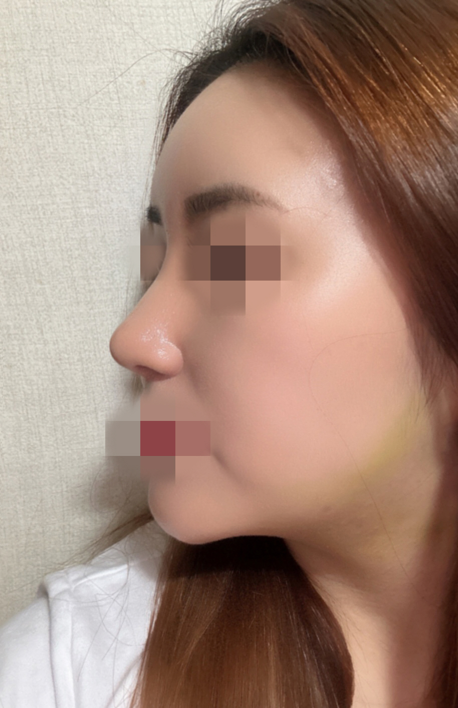 수술한지 2주차됐구요!