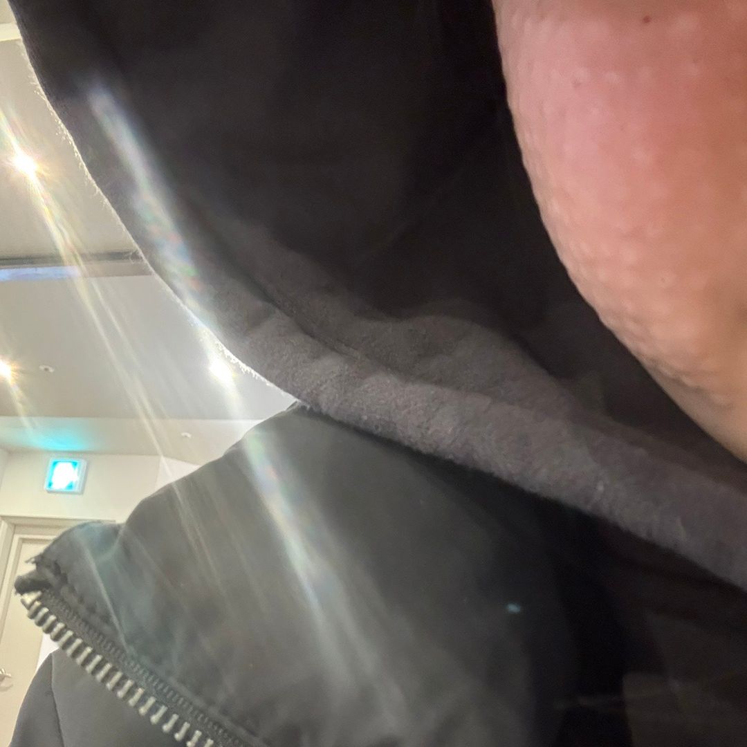얇은 피부도 꼼꼼하게! 대기 없이 바로 시술받았어요