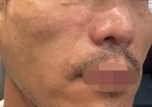 수면 리쥬란, 엠보도 확실하고 다른 병원들보다 만족도가 높습니다.
