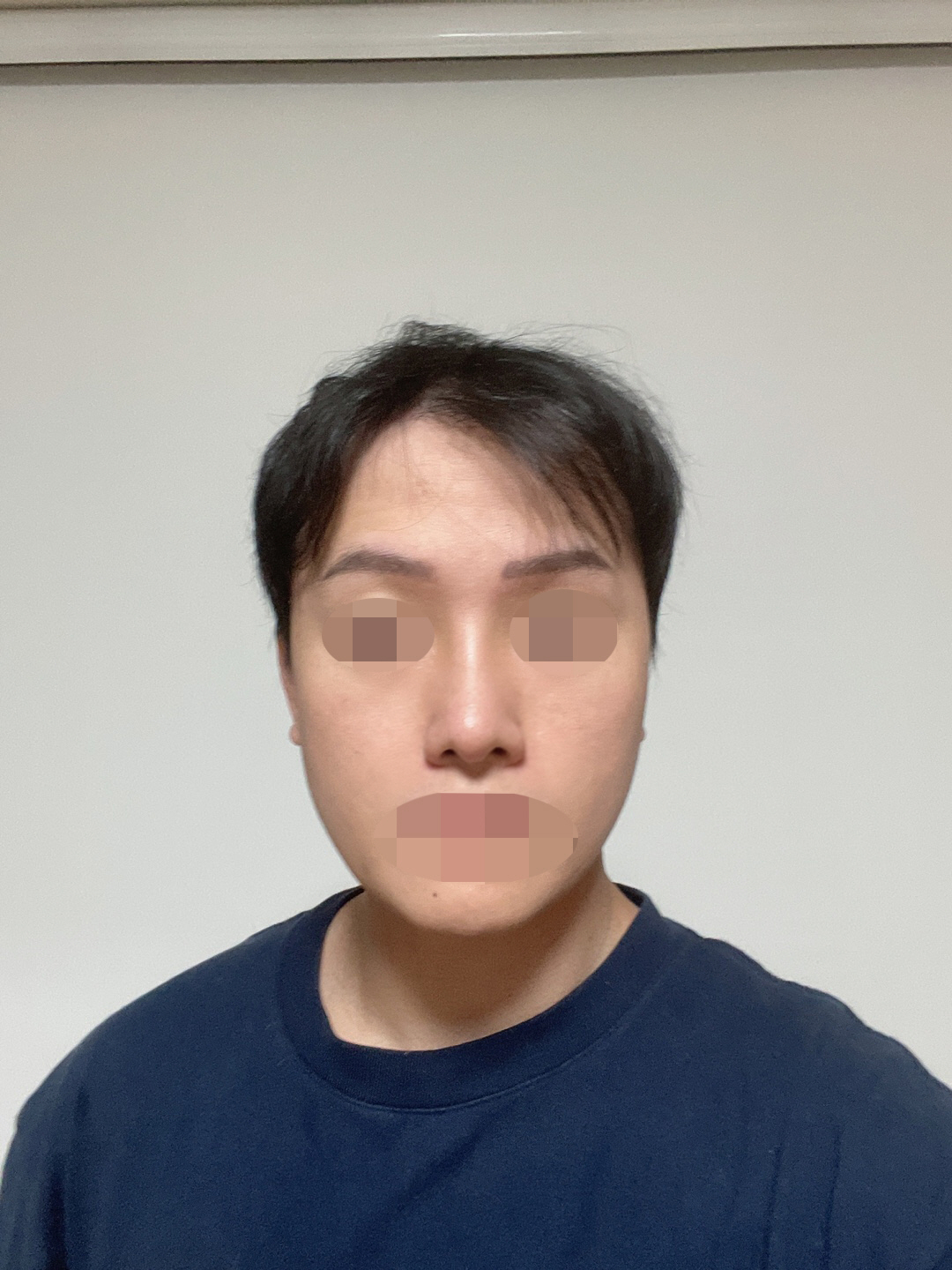 2주차가 되어서 붓기가 조금씩 빠졌어요