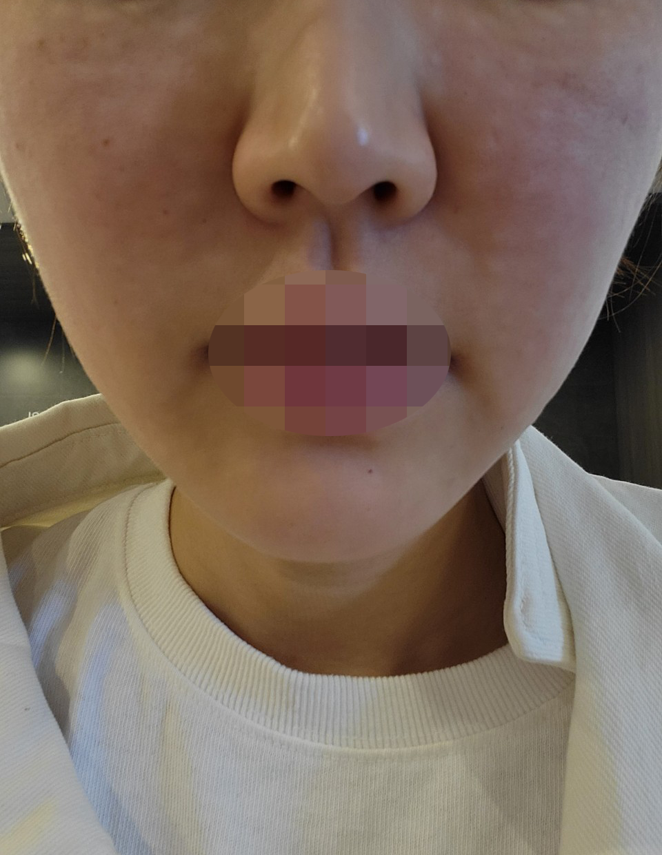 수면으로 통증 없이 리쥬란, 작년부터 꾸준히 이용하고 있어요