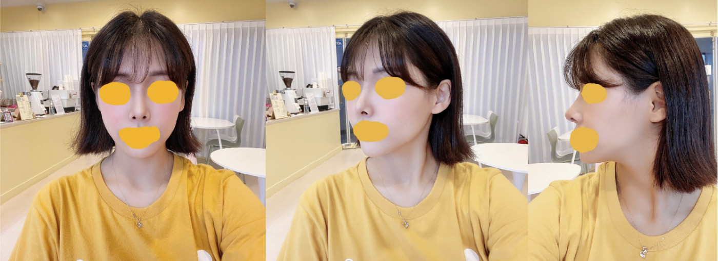 코 수술한지 두달차 후기입니다!!