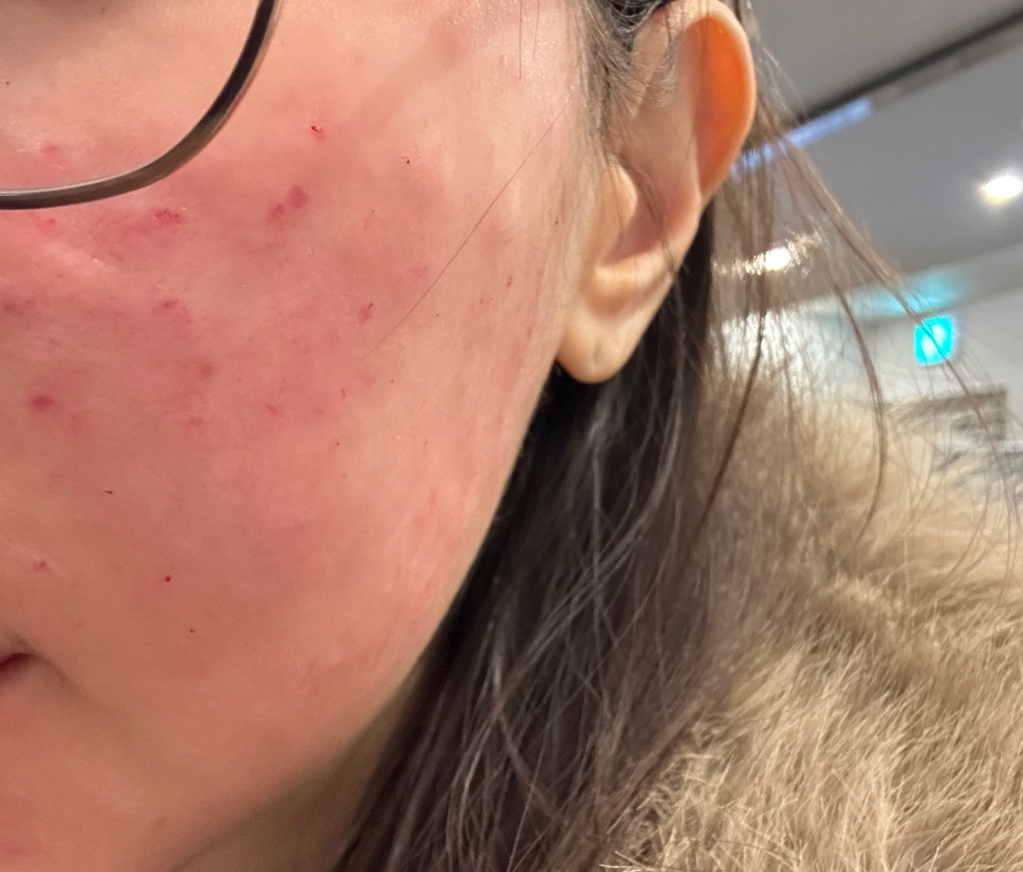 턱이랑 볼 건조해서 받았는데 요청대로 잘 해주신 것 같아요 ㅎㅎ