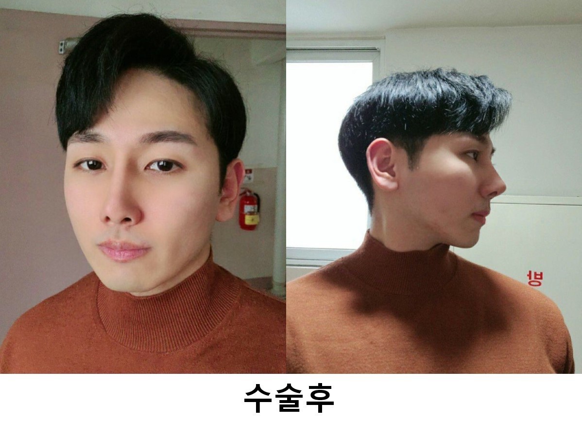 남자 코성형 5개월차