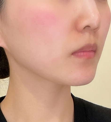 마이크로파로 진피층 자극, 얼굴 라인 정리에 딱 좋은 온다리프팅이에요