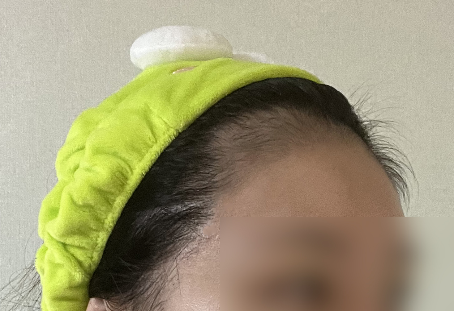비절개 비삭발 구렛나루 모발이식 2개월차, 점점 자리 잡아가는 중이에요