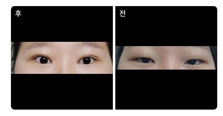 앞틈 쌍수 눈매교정