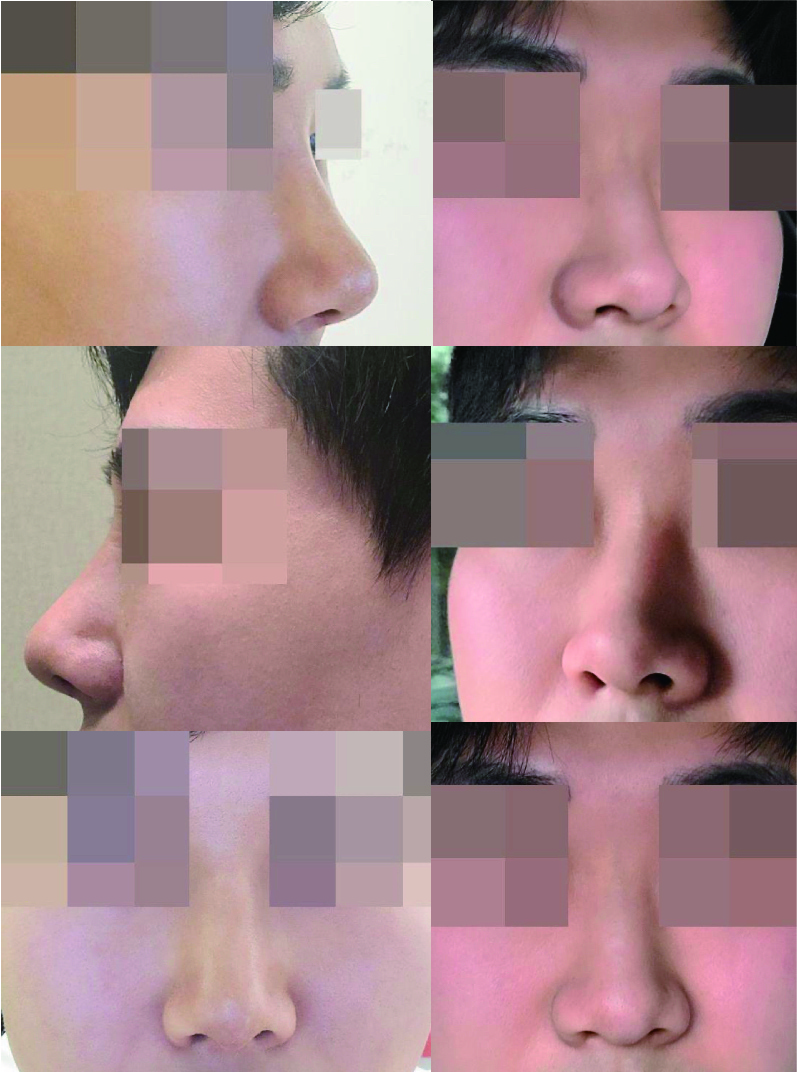 7일차 코수술후기