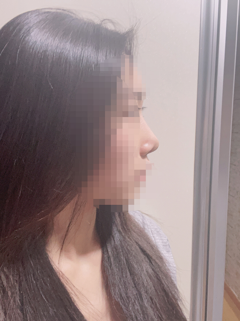 코 수술 성공적이에요