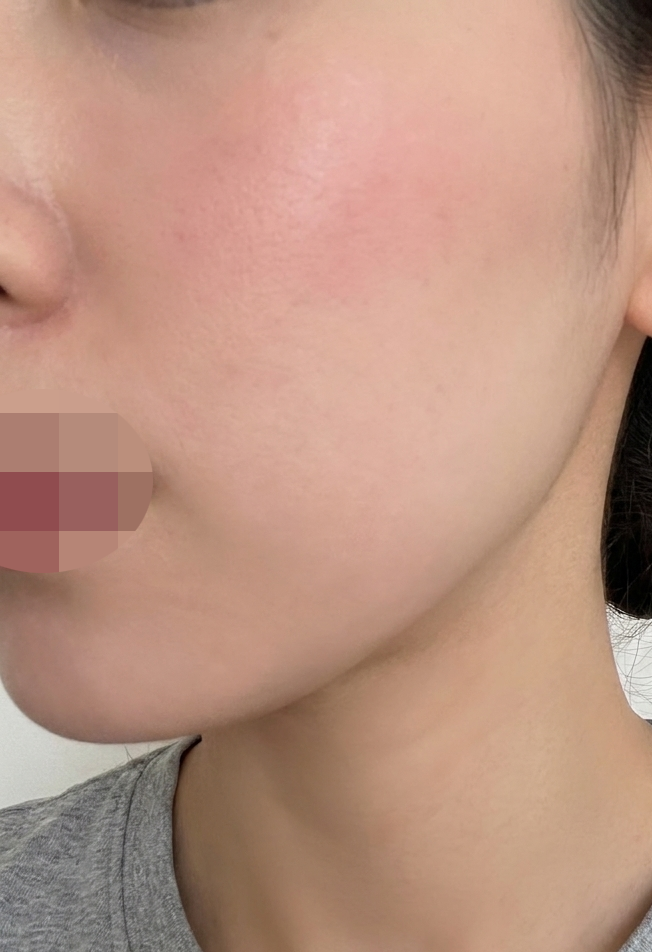 과하지 않게 꼭 필요한 부위만! 자연스러운 결과에 만족이에요~ㅎㅎ