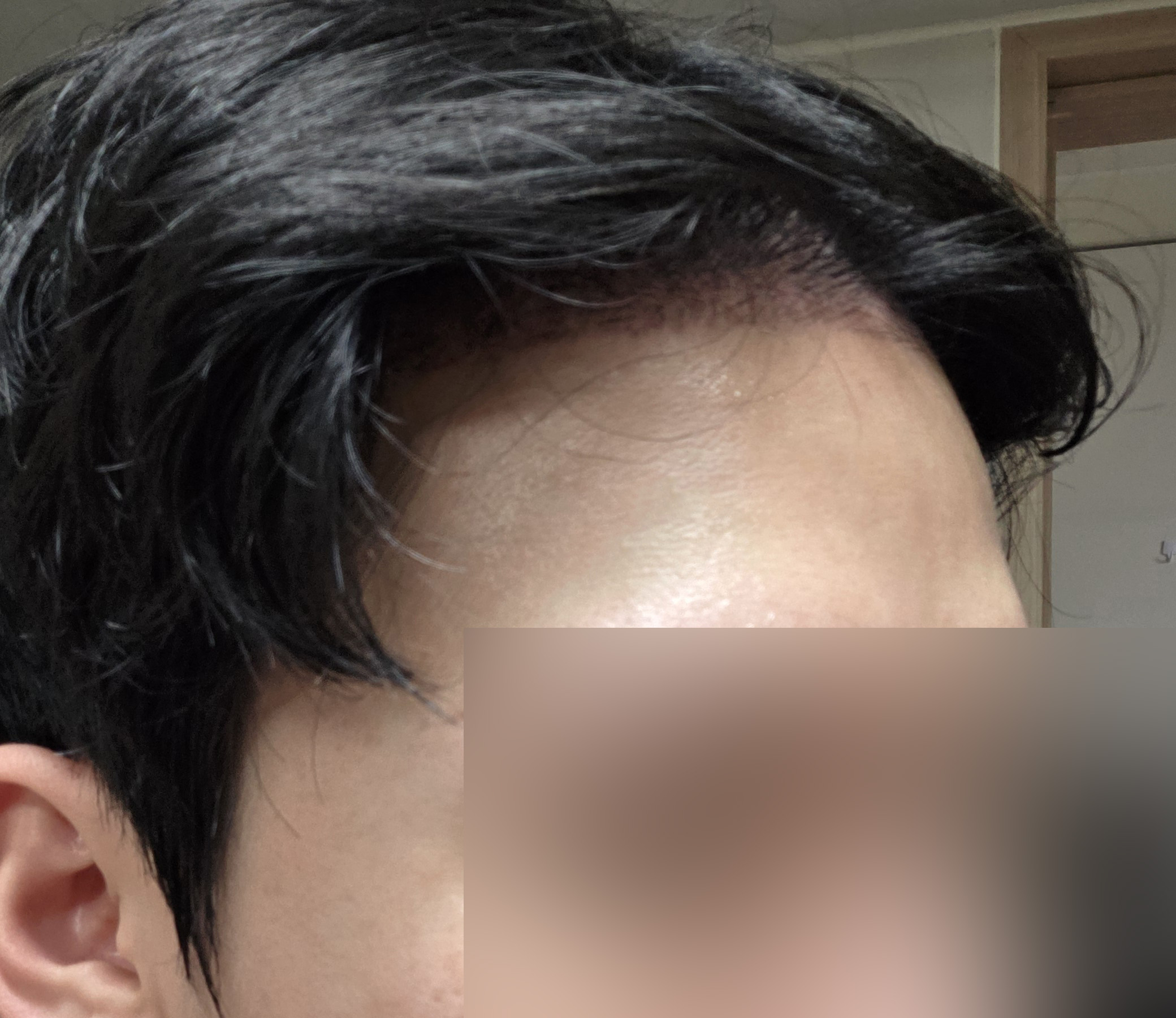 비절개 무삭발 2주차입니다! 벌써 헤어라인이 달라졌습니다!