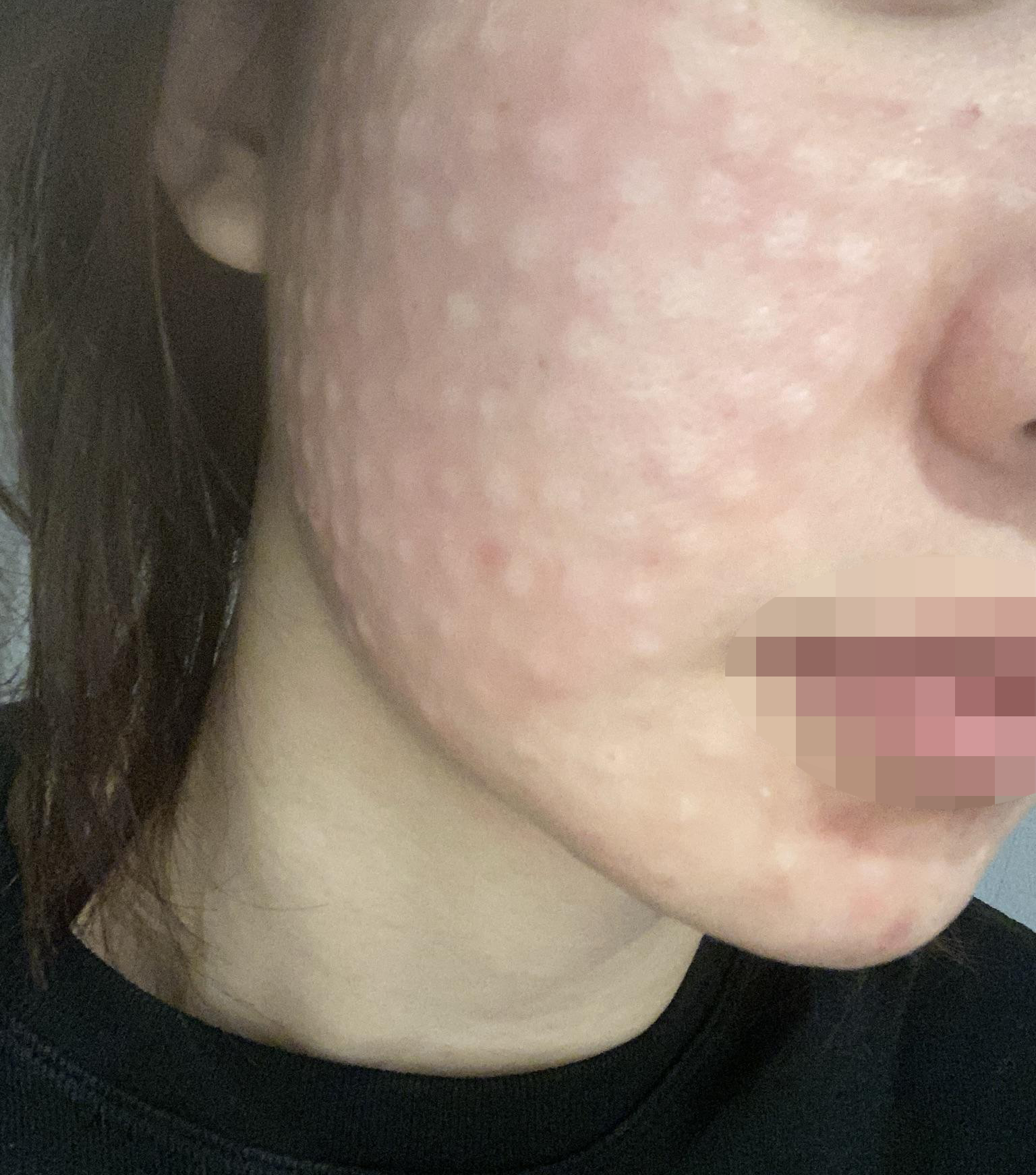 엠보 꼼꼼하게 올라와서 첫 리쥬란 결과가 너무 기대돼요~ㅎㅎ