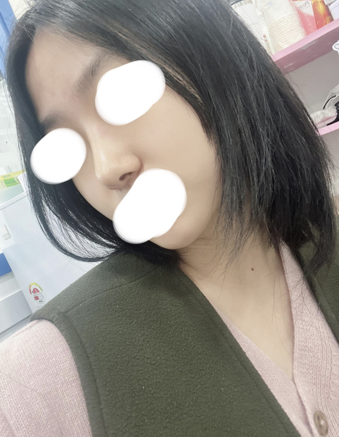 붓기가 쭉쭉빠지고 모양도 점점 얄쌍해지고 있어요 만족해요!