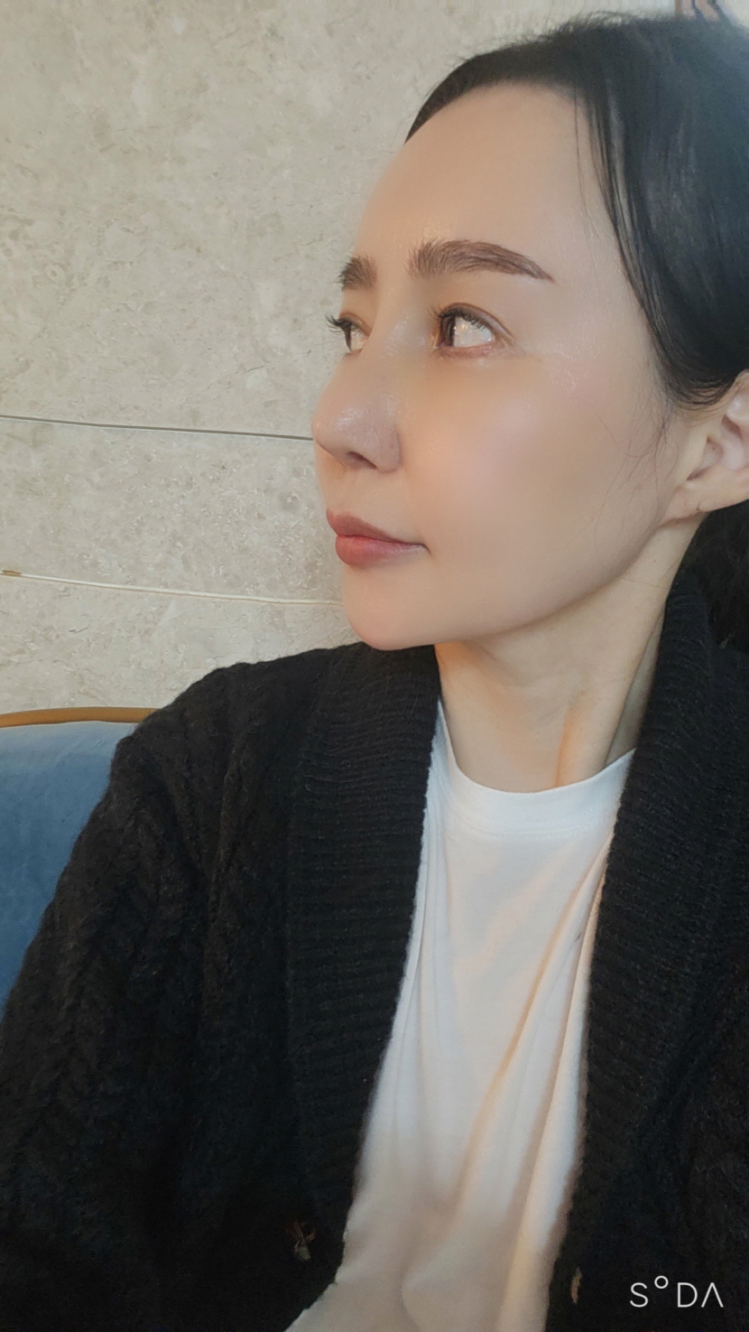 너무맘에들어요 붓기빠지면완전맘에들거같아요