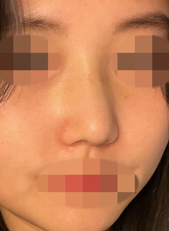 수술 후 코 모양이 예쁜데 또 자연스러워서 좋아요!