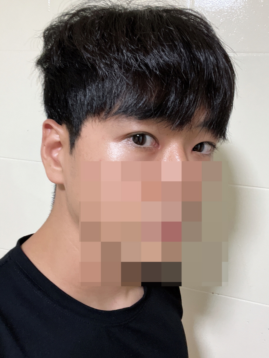 인상이 확실히 좋아졌고 눈뜨는것도 편해졌어요