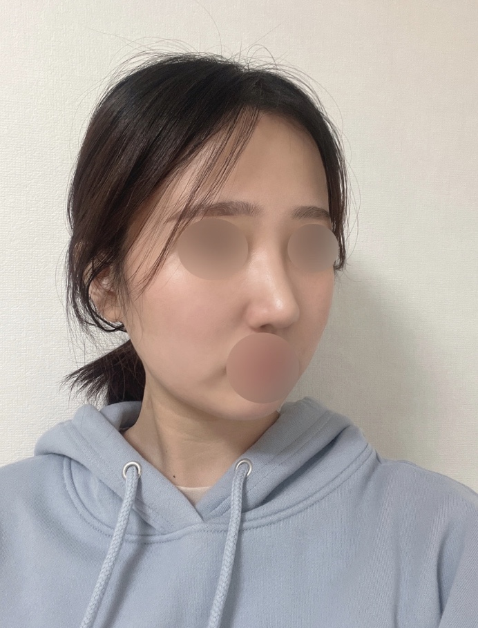 코수술 한달차 후기입니다!