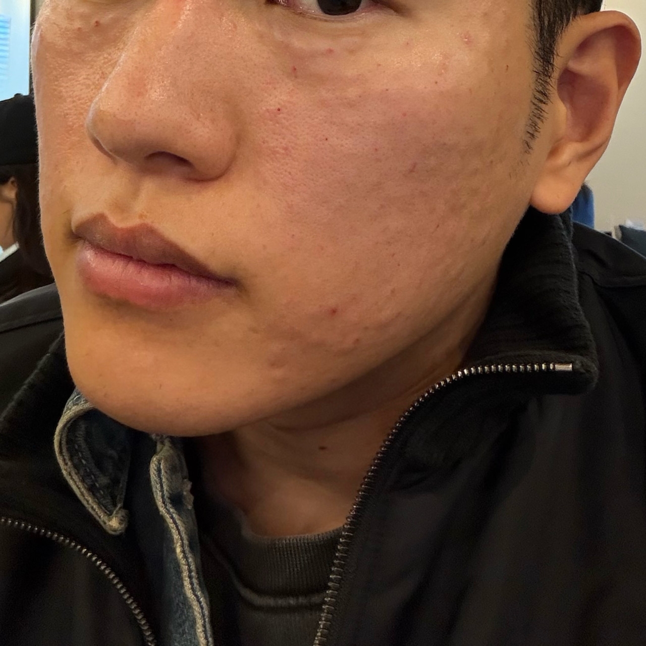 리쥬란 + 스킨보톡스 맞고 일주일 후기