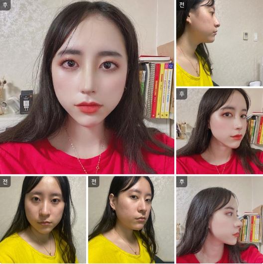 수술 일주일차????