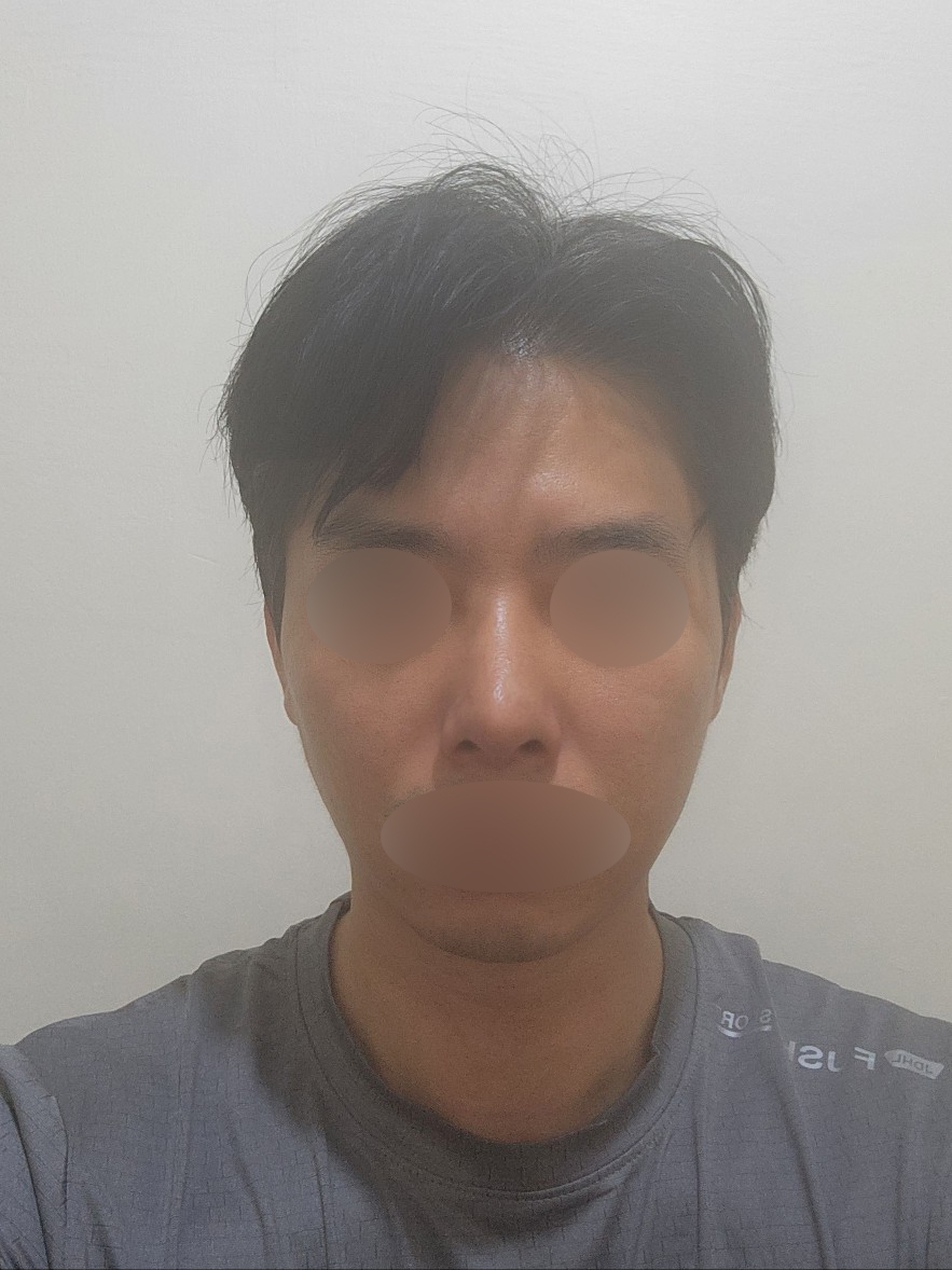 남자 코성형 1달차, 원래 제 코처럼 자연스러워요