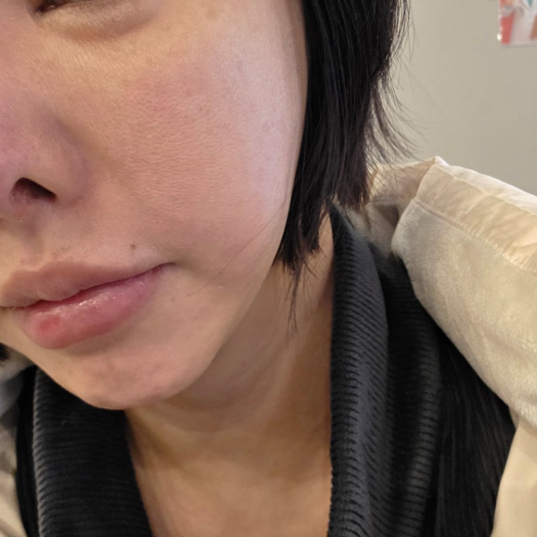 푸석했던 피부가 쥬베룩이랑 리쥬란 맞고 확 달라졌어요