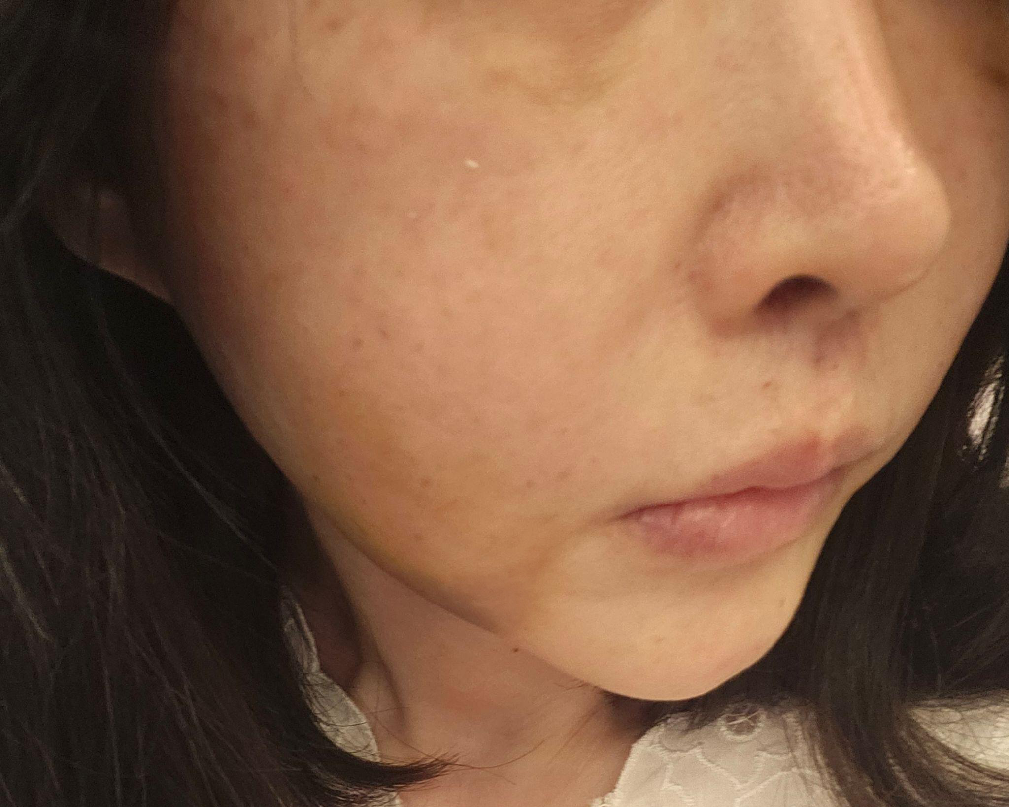 다른 곳에서 멍 심하게 들었던 기억에 걱정했는데 멍 없이 포텐자 받았어요!