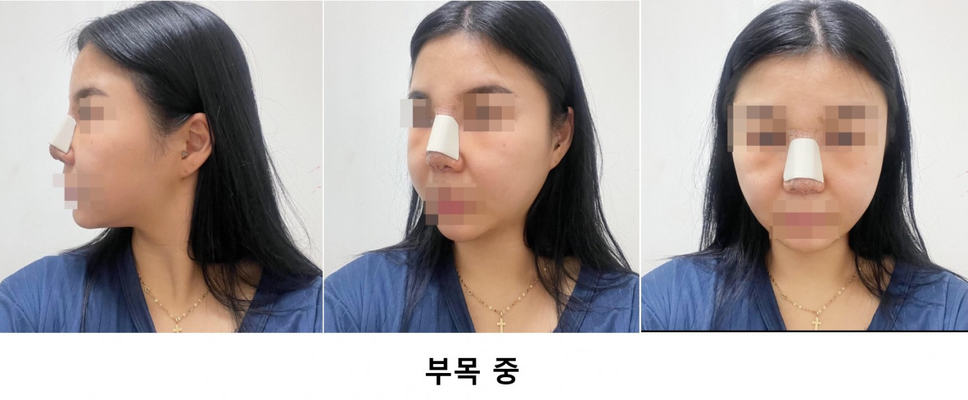 코 수술 3일 돼써용