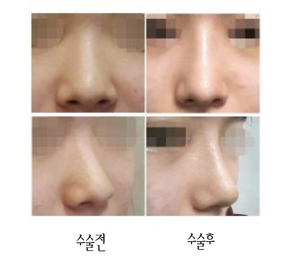 코수술 했어욤