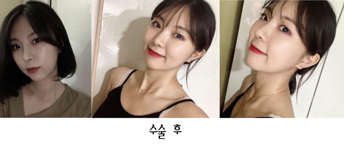 낮은코 짧은코 들창코 4개월째
