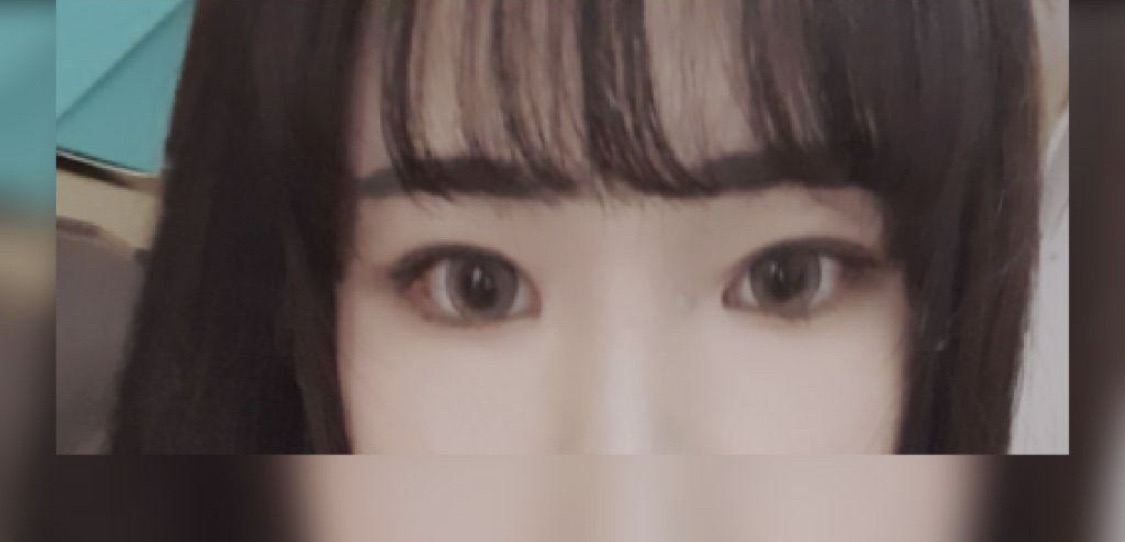박원장님께 쌍커풀, 눈매교정,앞트임하고와써요