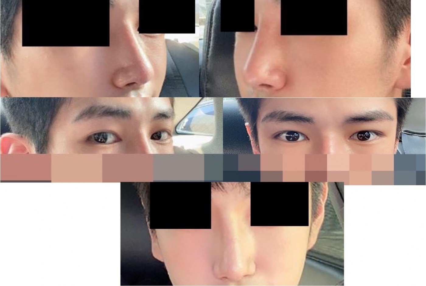 남자 눈코 후기입니다