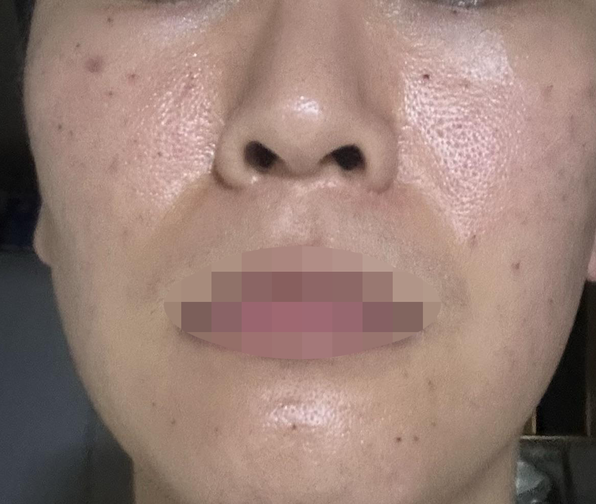쥬베룩+연어주사 수면으로 편하게 받아봤습니다.