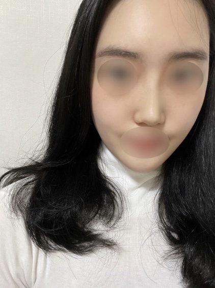 코수술+눈밑지방재배치 3주차