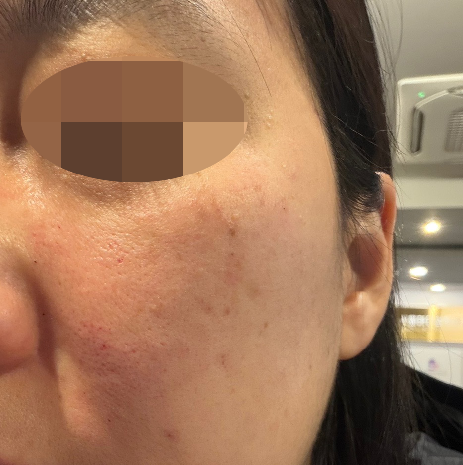 수분관리 받았는데 효과 좋은 느낌이에요 ㅎㅎ