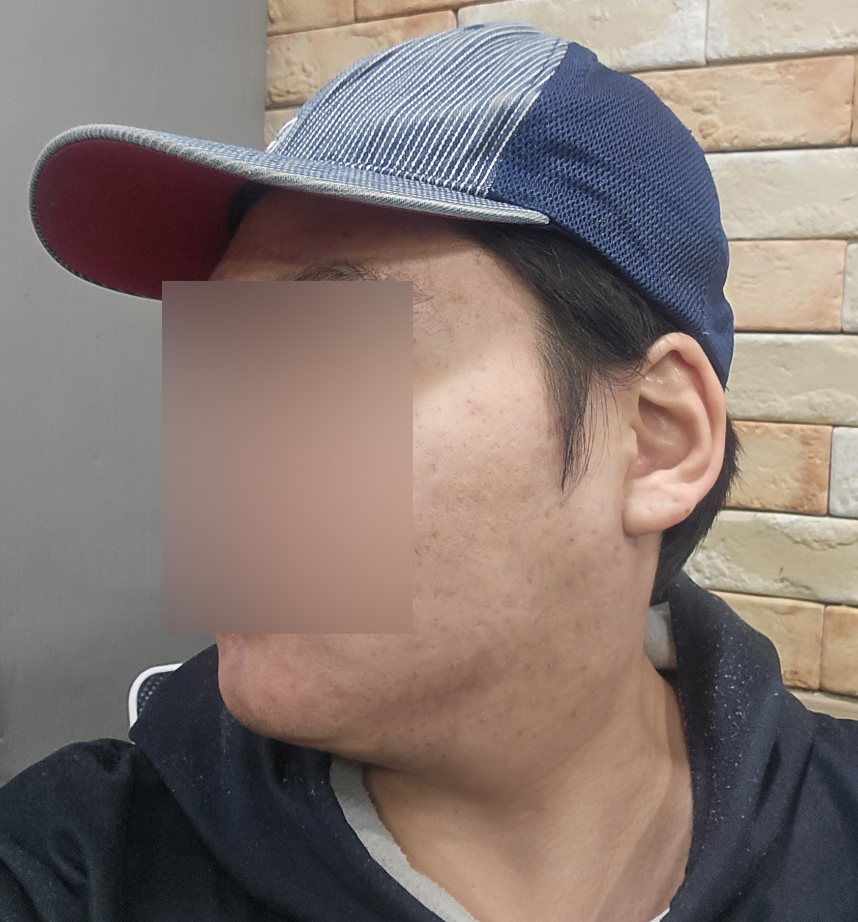 얼굴지방흡입 2주차, 턱살 빠지며 라인 정리된 후기