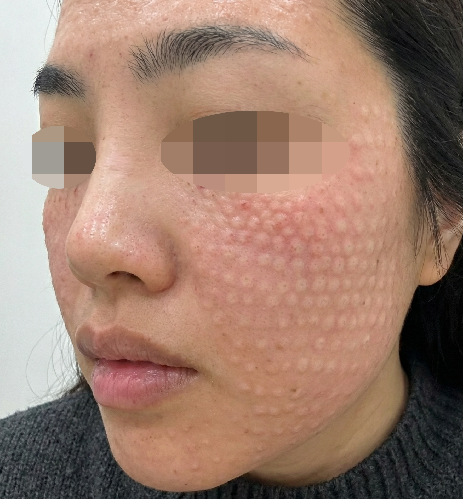 여기저기 맞아봤지만 리쥬란은 여기가 제일이에요~!