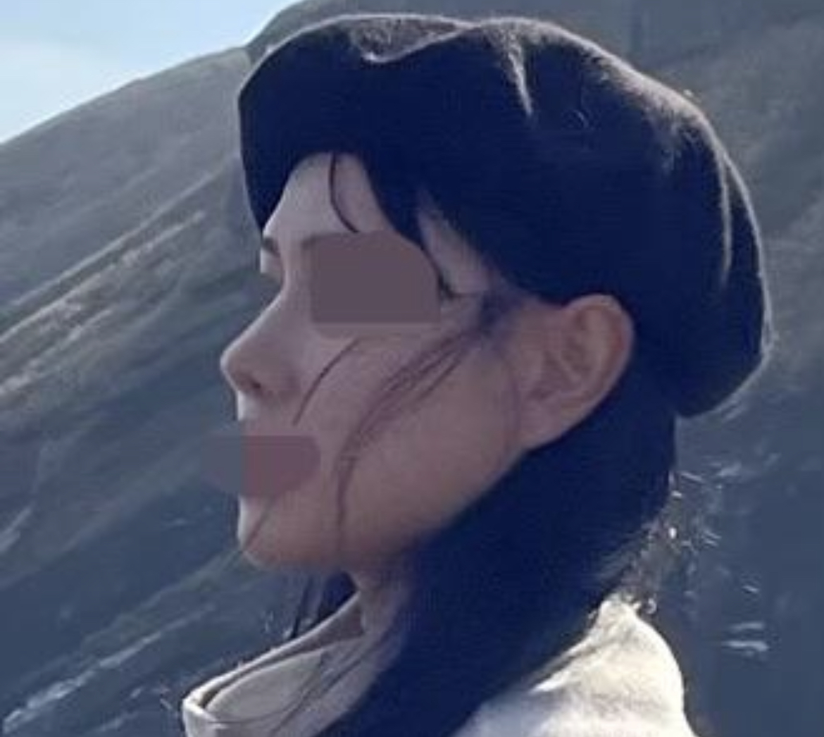 코수술 3개월차입니당~