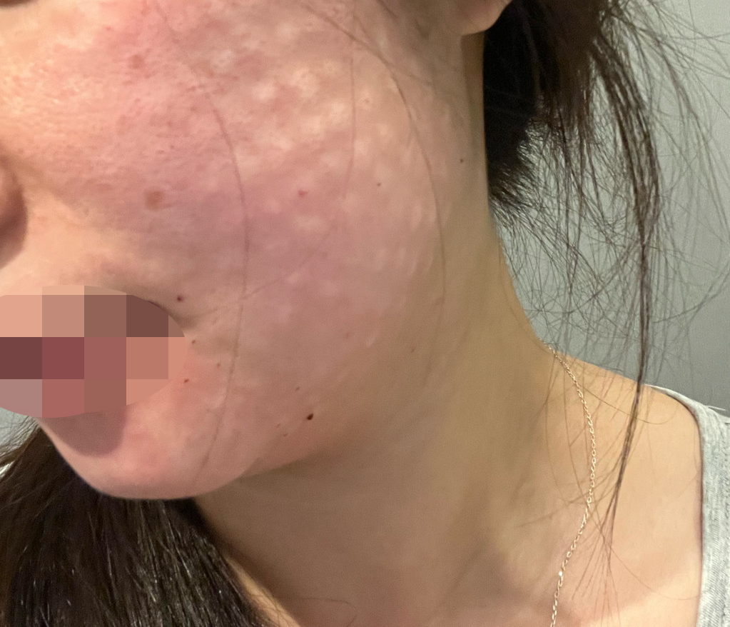 원장님 꼼꼼하고 상담 실장님도 친절한 리쥬란 받아봤어요